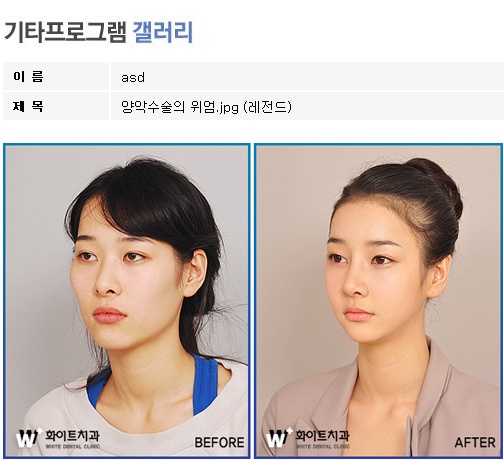 양악수술의위엄.jpg