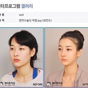 양악수술 레젼드녀 잇잖아 ㅇㅇ